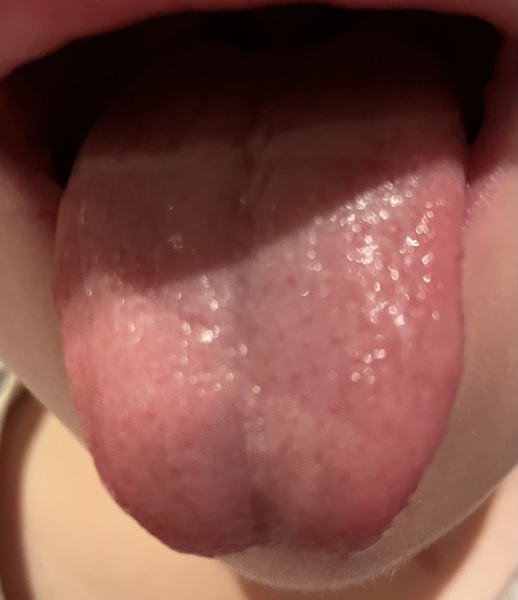Strawberry tongue?! Pics attached