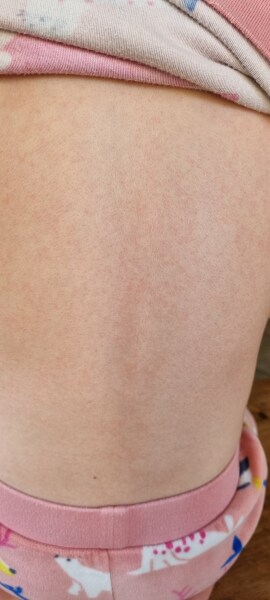 Strep A - are you worried?