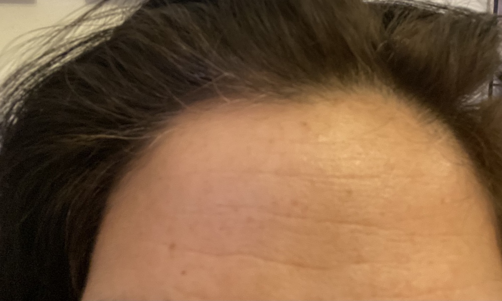 Had first Botox treatment - see no difference 