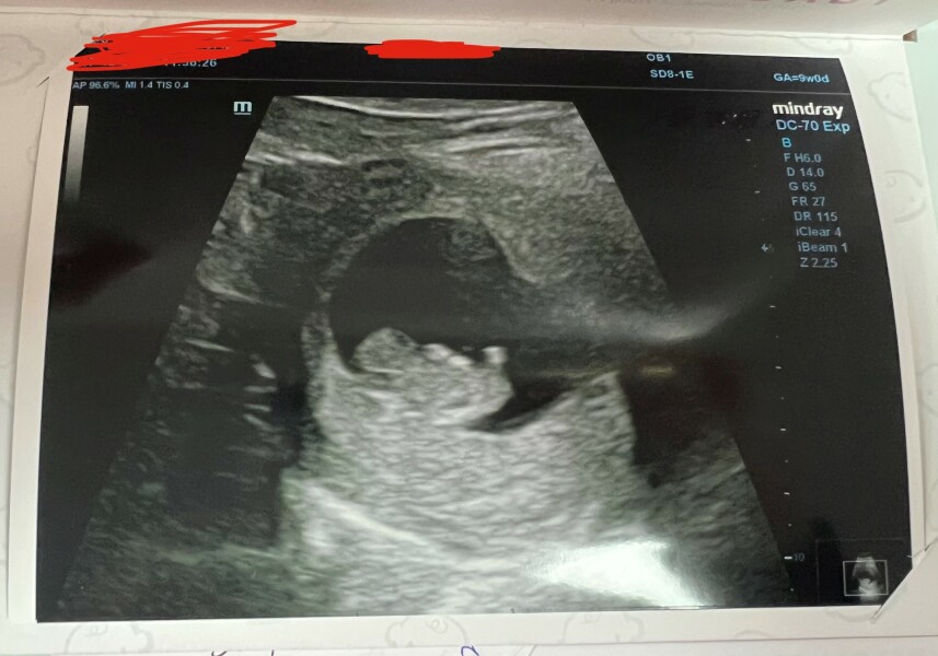 Experiences at private early scan at 9 weeks