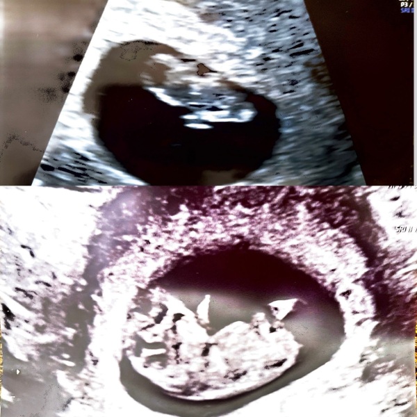 Experiences at private early scan at 9 weeks