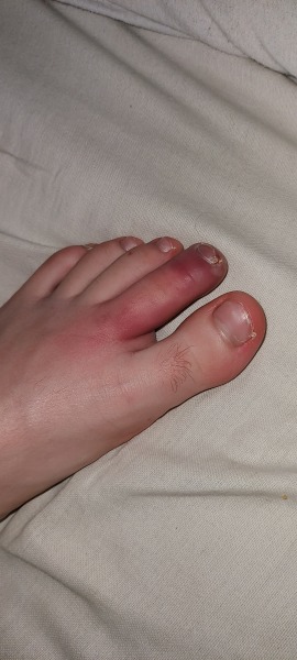 Does this need antibiotics? Pic included