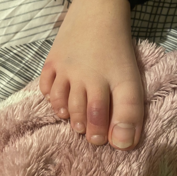 I think my daughter aged 10 has chilblains