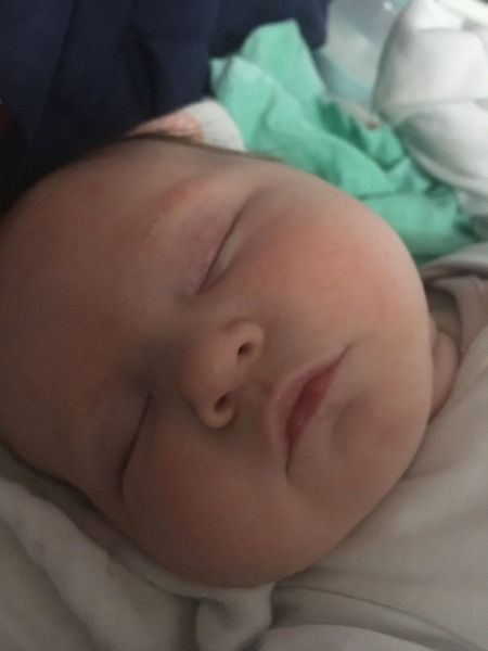 Baby allergy (pic?)