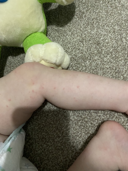What is this rash? 