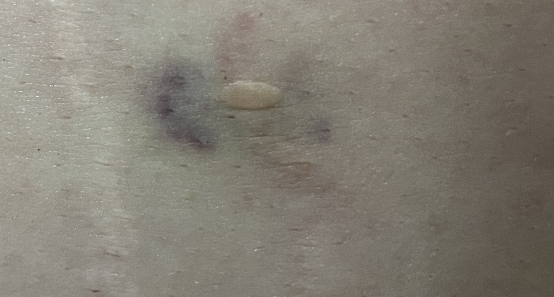 PHOTO warning: When to worry about a random bruise 