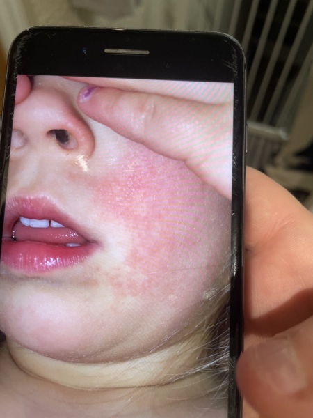 Rash on cheeks! Please help!