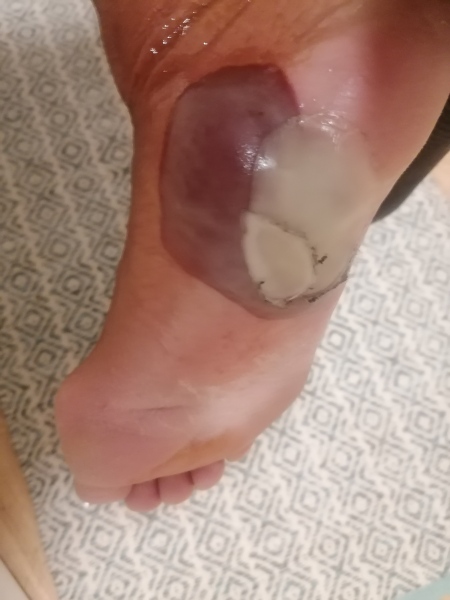 Advice re really painful blister on foot WARNING.. GROSS PIC ATTACHED