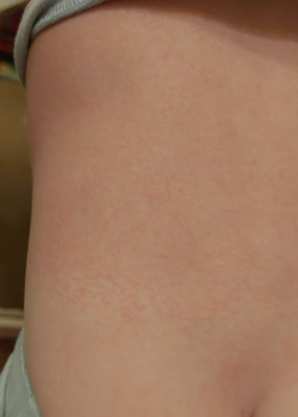 Confused about scarlet fever 