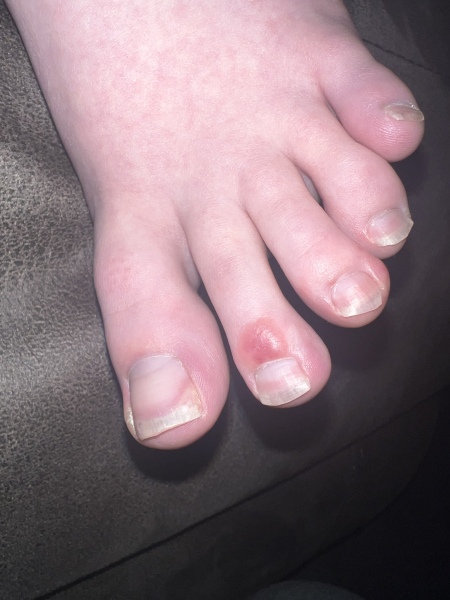 Chilblains? * warning feet photos *