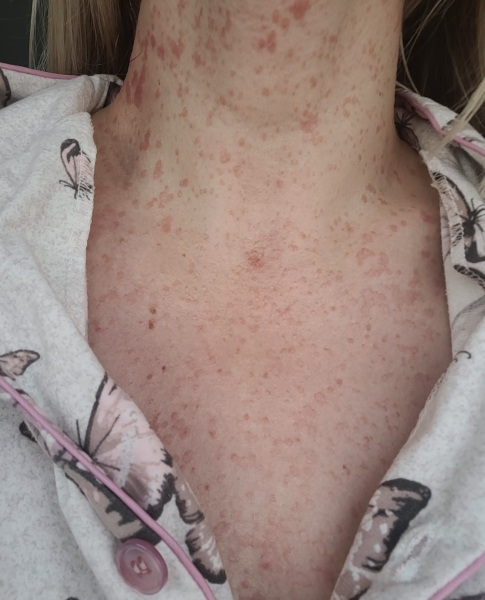 Please help me identify this rash