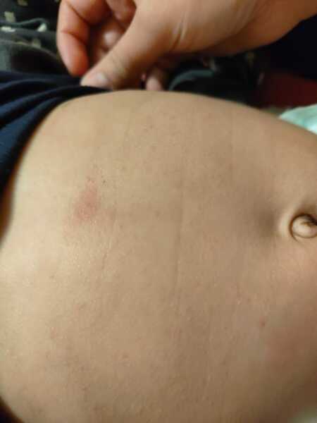 Could anyone help with what this rash might be on a 6 month olds stomach.
