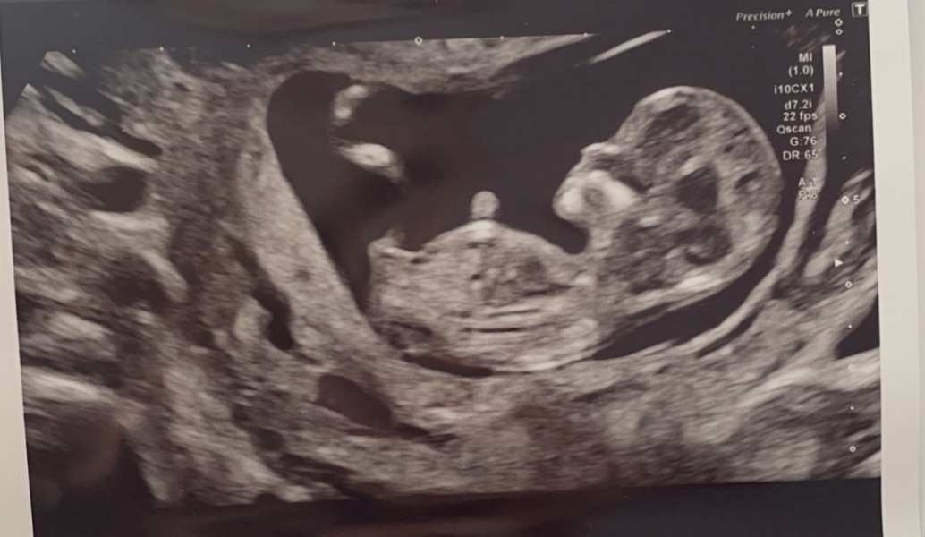 Is this a boy or girl scan? 
