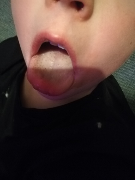 Strep? 