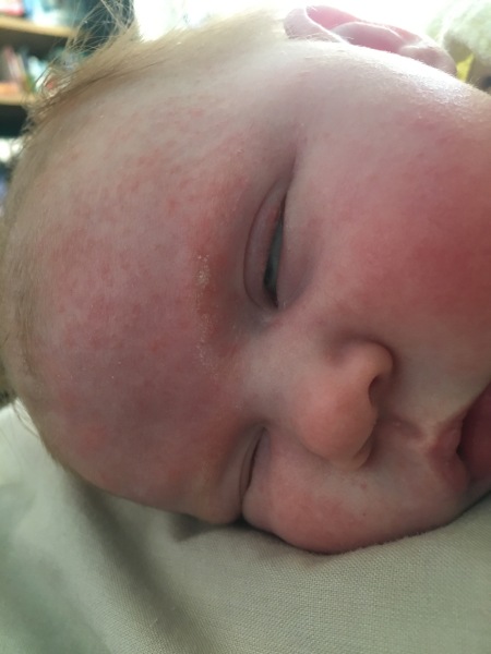 Baby allergy (pic?)
