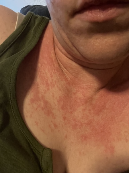 Please help, allergic reaction/scarlet fever or something else. 