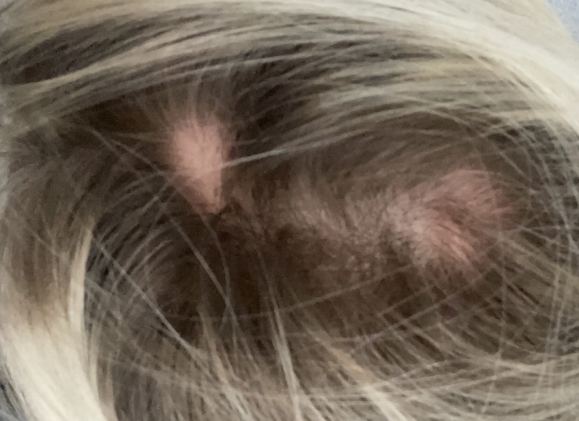 Hair loss … any advice 