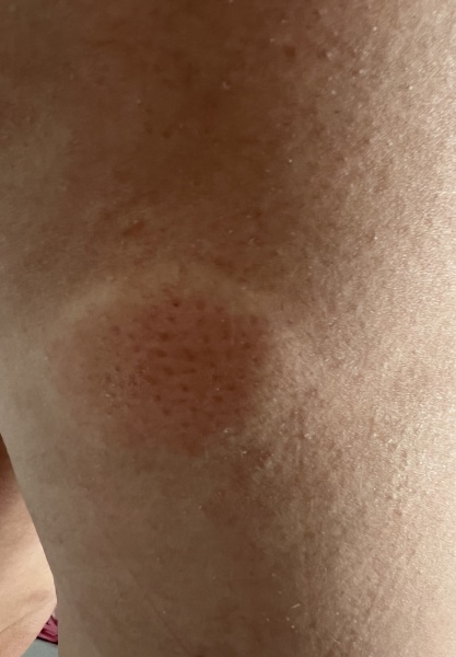 Bite on back of thighs