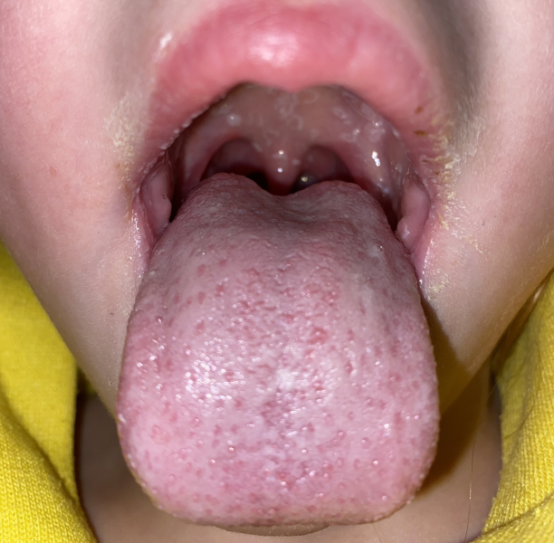 DS has fever and sore throat - strep A?