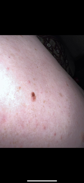Melanoma what next?