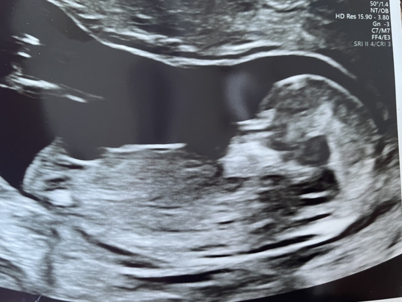 Baby gender