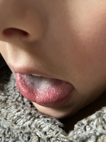 Strep a tongue
