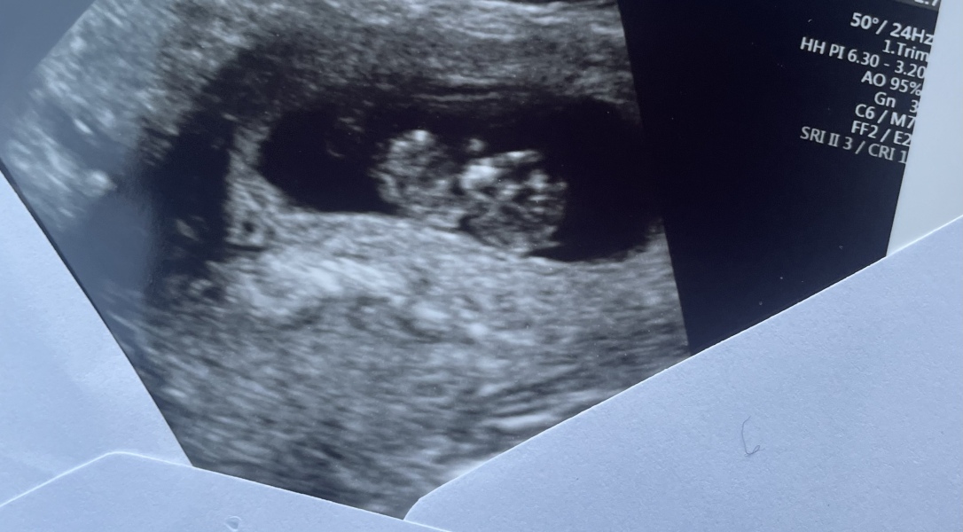 Boy or girl? Nub/skull theory