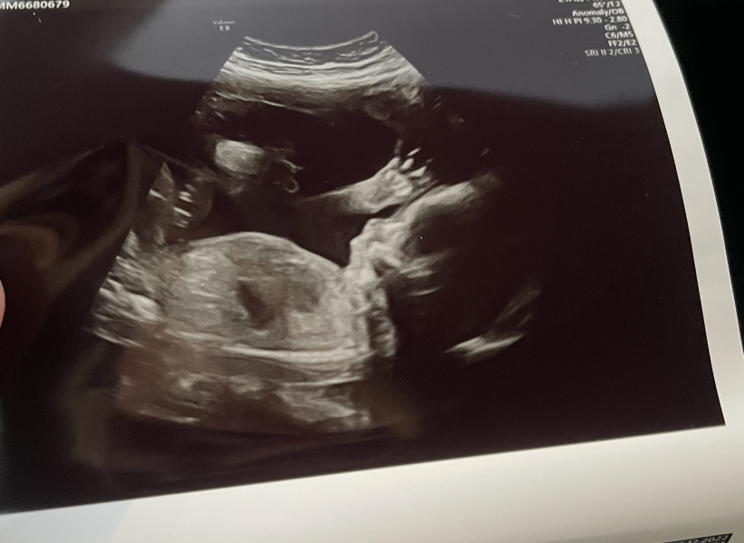 Very early pregnancy and so much anxiety after miscarriage