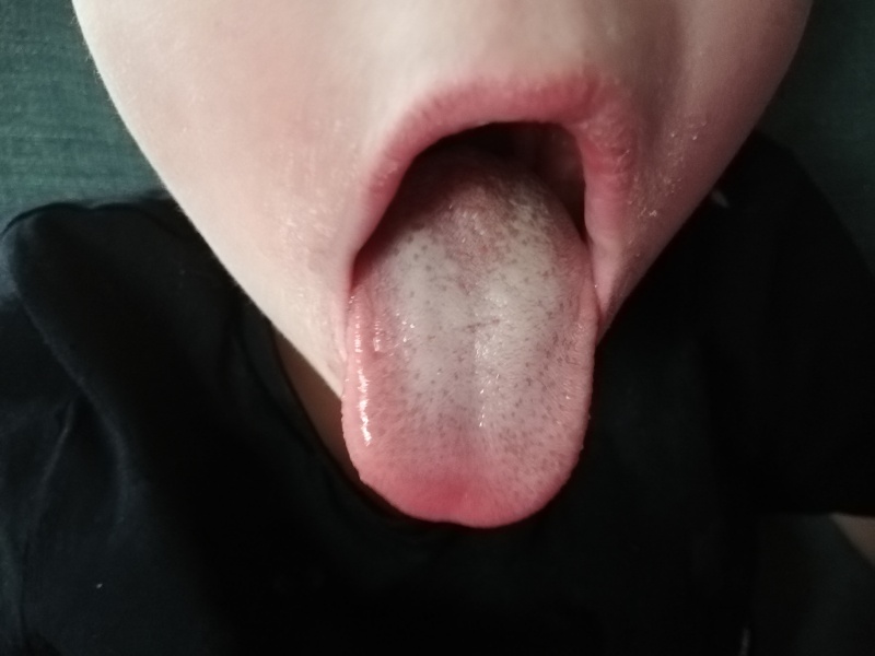 Strep? 