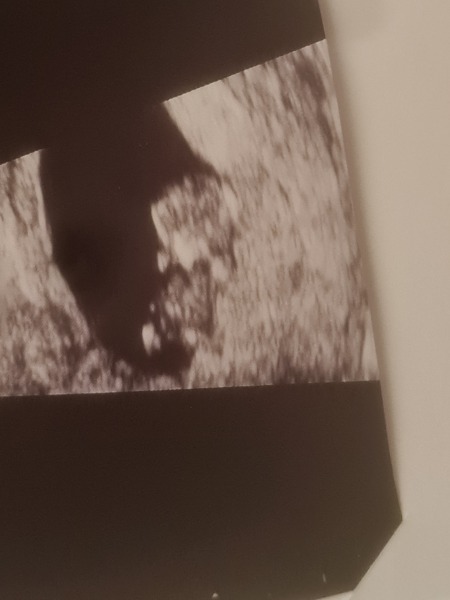 Experiences at private early scan at 9 weeks