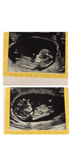 The nub theory..Twins!