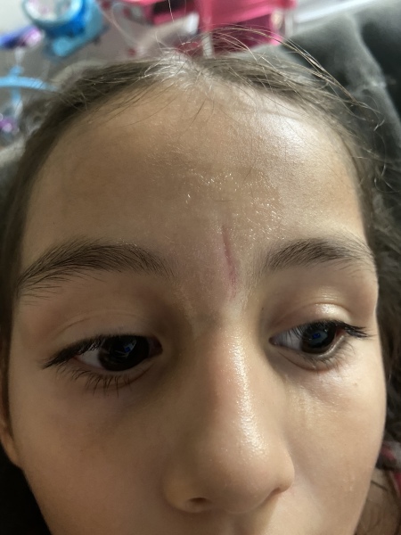 Help! Scar on my LO's face