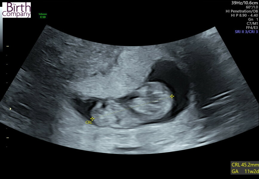 Pregnant after ivf - 5 weeks 