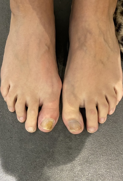 Swollen, red, hot toe (with pic)