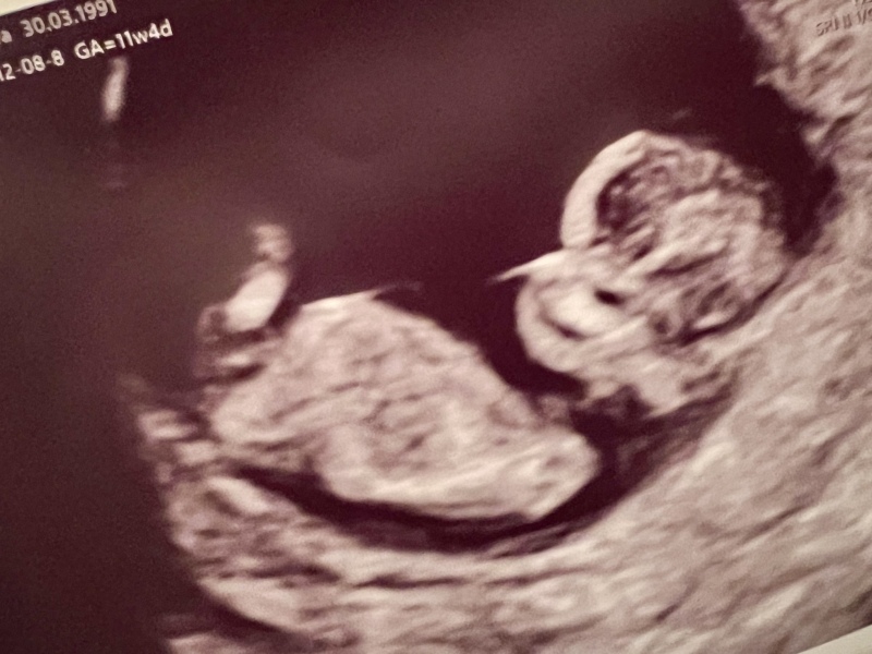 Nub Guesses?? (Will post sex screening result next week!)