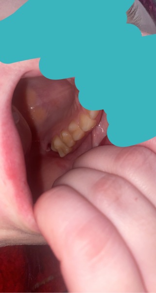 Is my tooth extract healing 