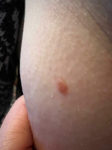 Flattish mole Puffed up- barely slept 
