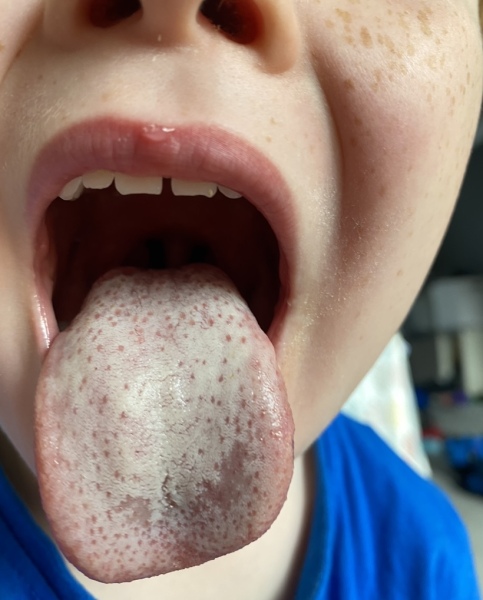 Positive Strep A / Scarler Fever stories please