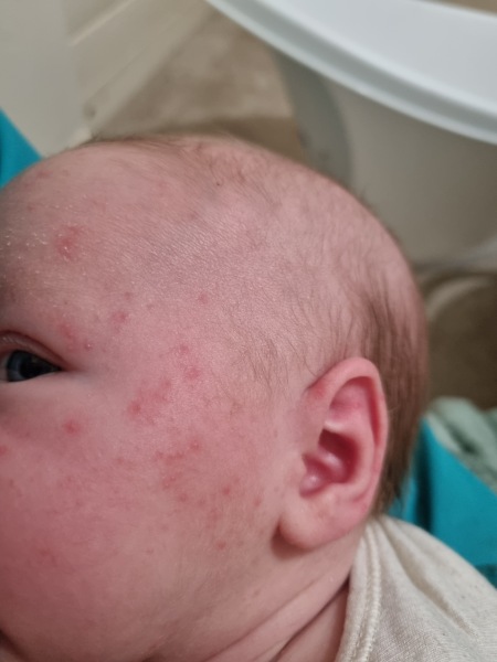 CMPA/reflux/ newborn skin rash