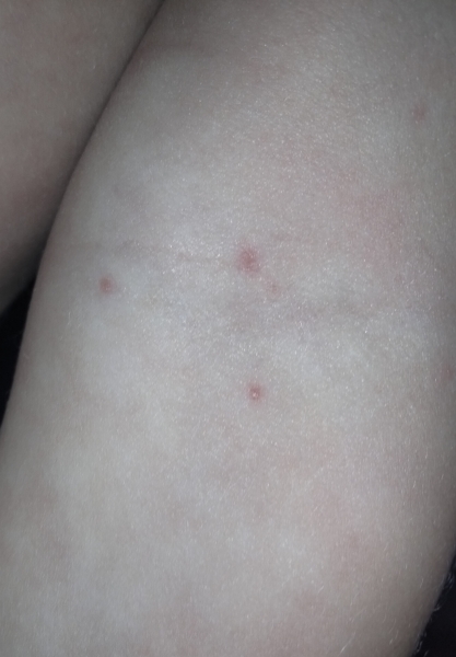 Potential chicken pox 