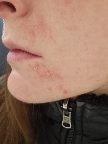 Recent change in skin 