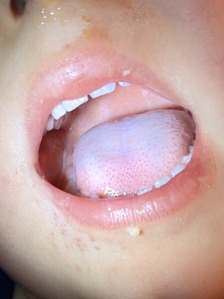 Scarlet Fever/Strep A - When is it an emergency?