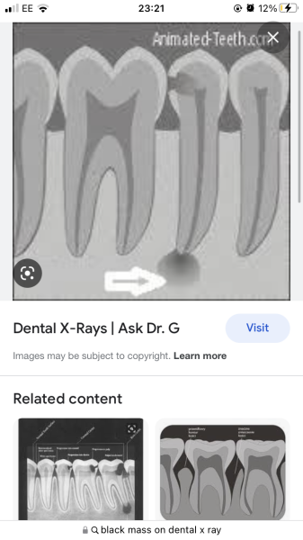 Incisor - Extraction or try to save it ? 