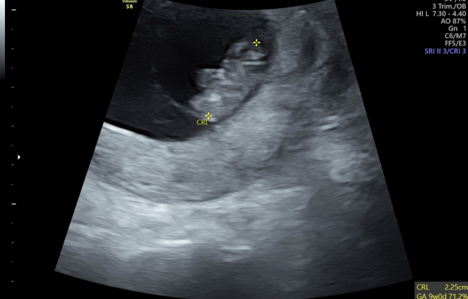 Pregnant after ivf - 5 weeks 