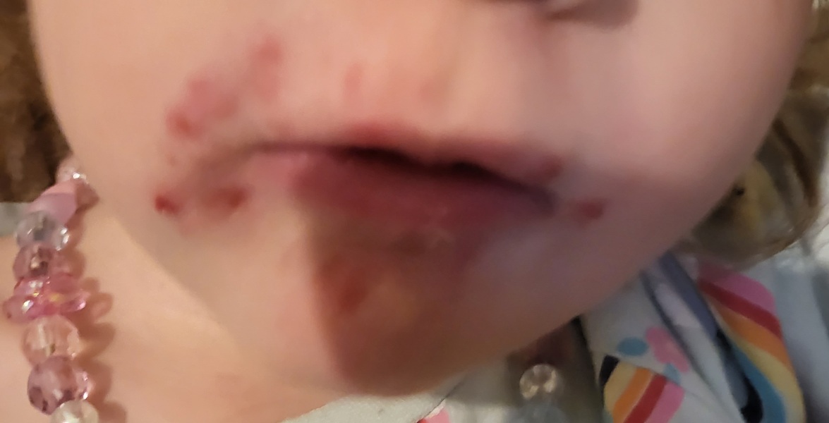 Is this impetigo? 