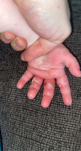 Doctor says chicken pox but I’m skeptical 