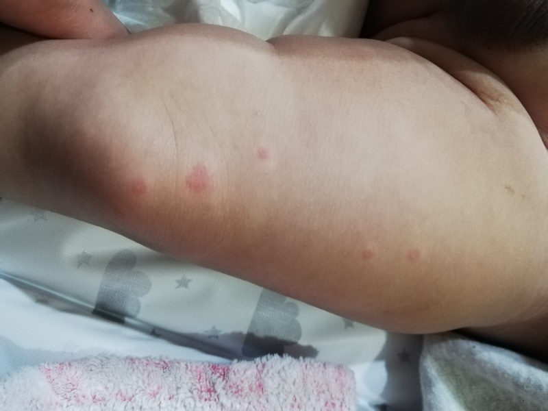 Rash 