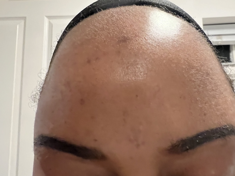 Laser for pigmentation on black skin