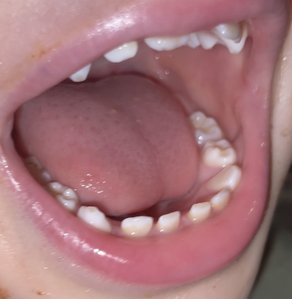 Positive Strep A / Scarler Fever stories please