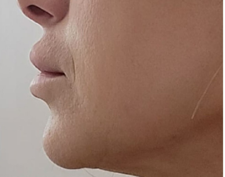 Lip filler dissolving 